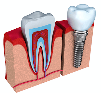  Preguntas frecuentes implantes dentales - Clínica dental Dr. Ferrer | Madrid