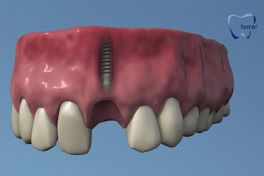 preguntas frecuentes implantes dentales