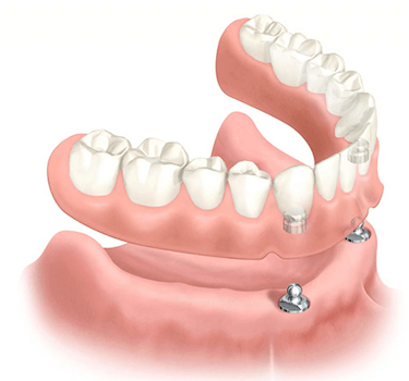 protesis dental removible sobre implantes dentales