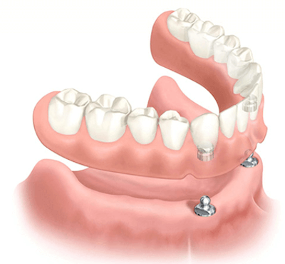 ayer trabajador paquete Prótesis dental removible sobre implantes dentales | Clínica Dr. Ferrer