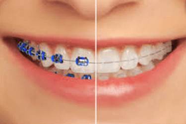 brackets de color transparente