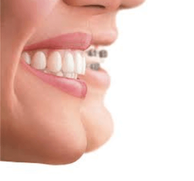  Tratamientos de ortodoncia: tipos y precio - Clínica dental Dr. Ferrer | Madrid