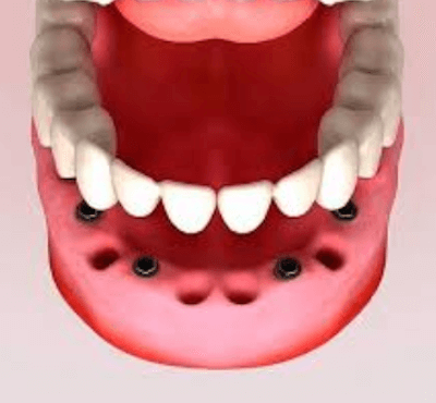  Implantes dentales en toda la boca: recupera tu dentadura - Clínica dental Dr. Ferrer | Madrid