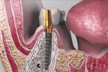 complicaciones de los implantes dentales