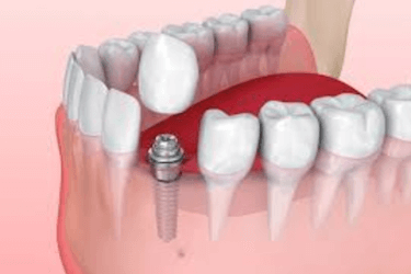 complicaciones implantes dentales despues