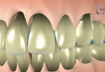 encías retraídas gingivitis