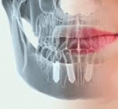  Complicaciones de los implantes dentales - Clínica dental Dr. Ferrer | Madrid