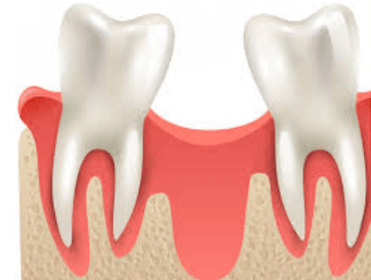 complicaciones de los implantes antes