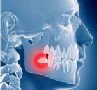  5 Consejos para el dolor de las muelas del juicio o cordales - Clínica dental Dr. Ferrer | Madrid