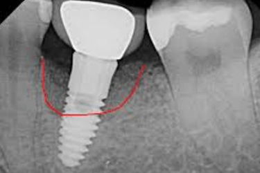 perdida hueso implantes tabaco