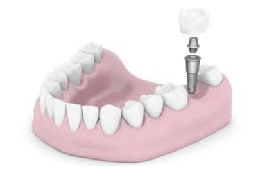 mejores implantes dentales