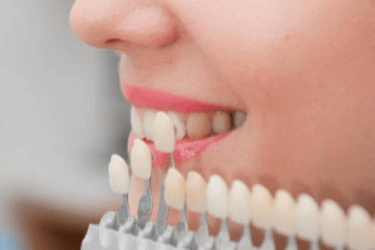 cuidados de las carillas dentales