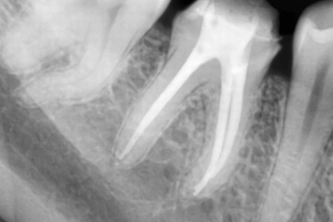 precio endodoncia