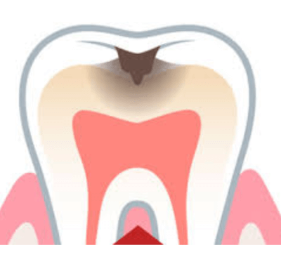  ¿Cuál es el precio de una endodoncia? - Clínica dental Dr. Ferrer | Madrid