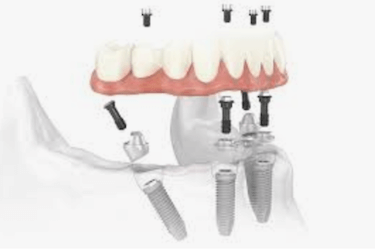 Implantes dentales en el mismos dia