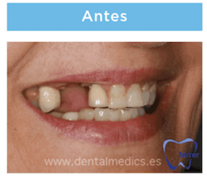 implantes dentales multiples antes