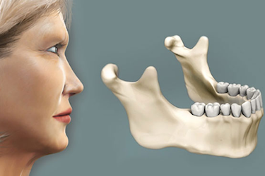 implantes dentales poco hueso