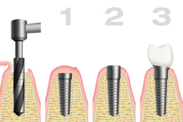 Proceso colocación implantes