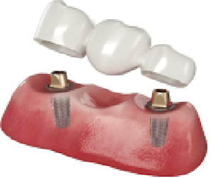 2 implantes dentales y protesis