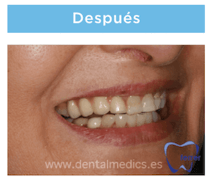 implantes multiples despues