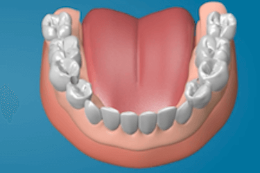 coste protesis dental hibrida