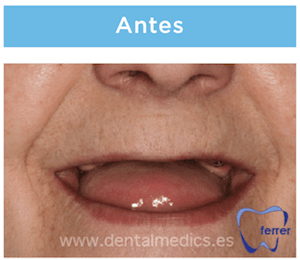 protesis con implantes dentales antes