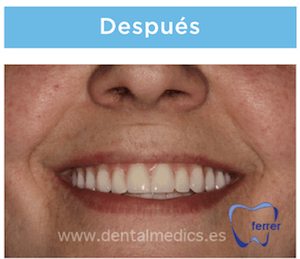 protesis con implantes dentales despues