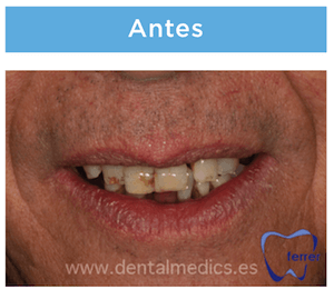 implantes dentales antes