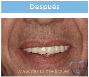 implantes dentales despues