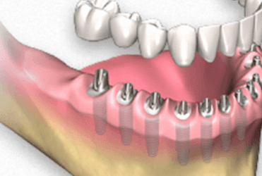 protesis dentales fijas con implantes dentales