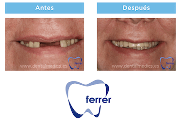 antes y despues implantes