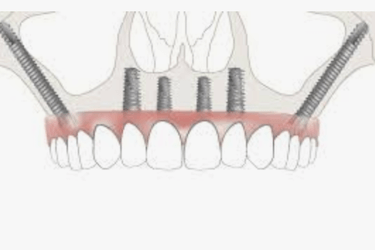 implantes dentales cigomaticos