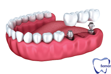 tratamientos implantes dentales