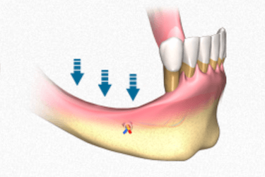 implantes dentales poco hueso