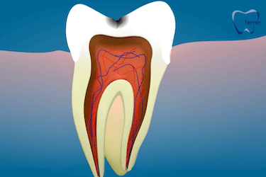 muela con caries