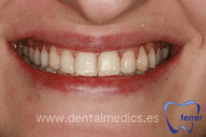 despues brackets esteticos ortodoncia estetica despues