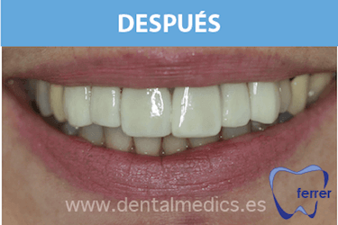 carillas dentales Dr. Ferrer