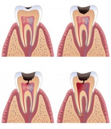 caries diente