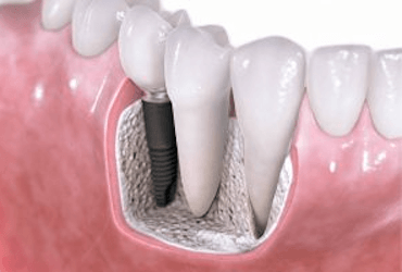 injerto de hueso dental