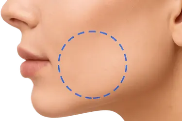 Zona facial marcada para intervención de bichectomía en Madrid en Clínica Dental Medics Dr. Ferrer