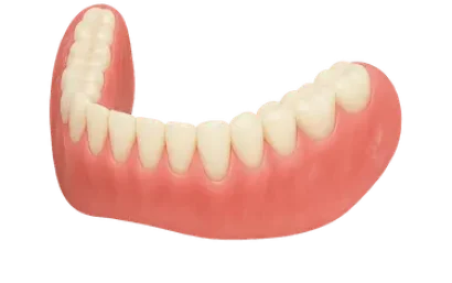 Prótesis dental removible sobre implantes en arcada inferior con encía y dientes artificiales