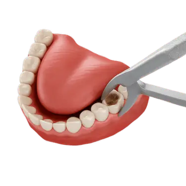 Extracción dental previa al implante que puede influir en el precio del tratamiento con implantes
