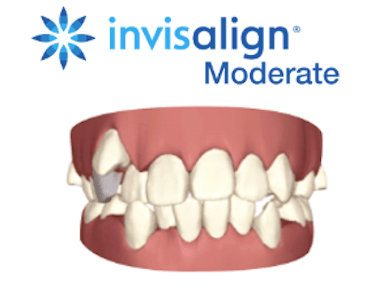 Invisalign Moderate