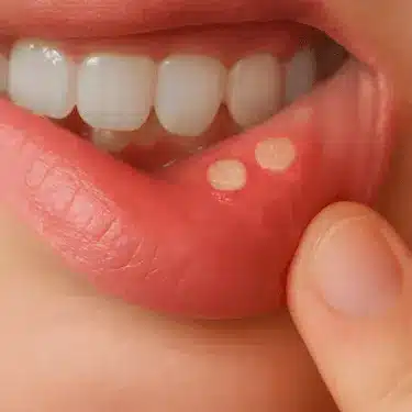 Úlceras o aftas bucales en la mucosa del labio inferior con lesión visible