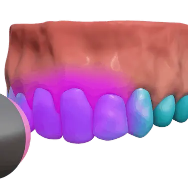 Aplicación de gel blanqueador activado con luz LED durante blanqueamiento dental profesional