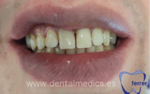 Antes