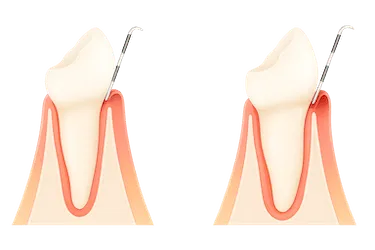 Limpieza dental profesional para mantener encías sanas tras tratamiento periodontal
