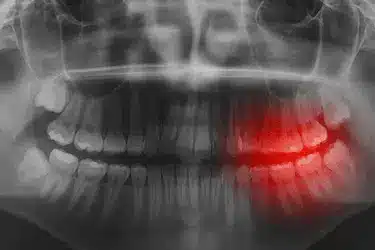 Radiografía dental con infección e inflamación, posible causa de halitosis dental