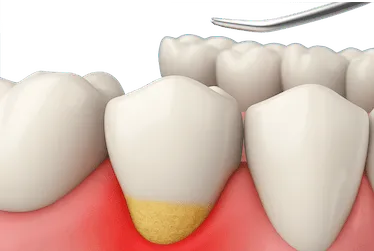 Curetaje dental con instrumento para eliminar sarro bajo la encía inflamada