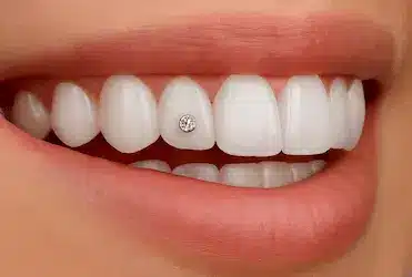 Piercing dental con joya en incisivo superior realizado en Clínica Dental Dr. Ferrer en Madrid